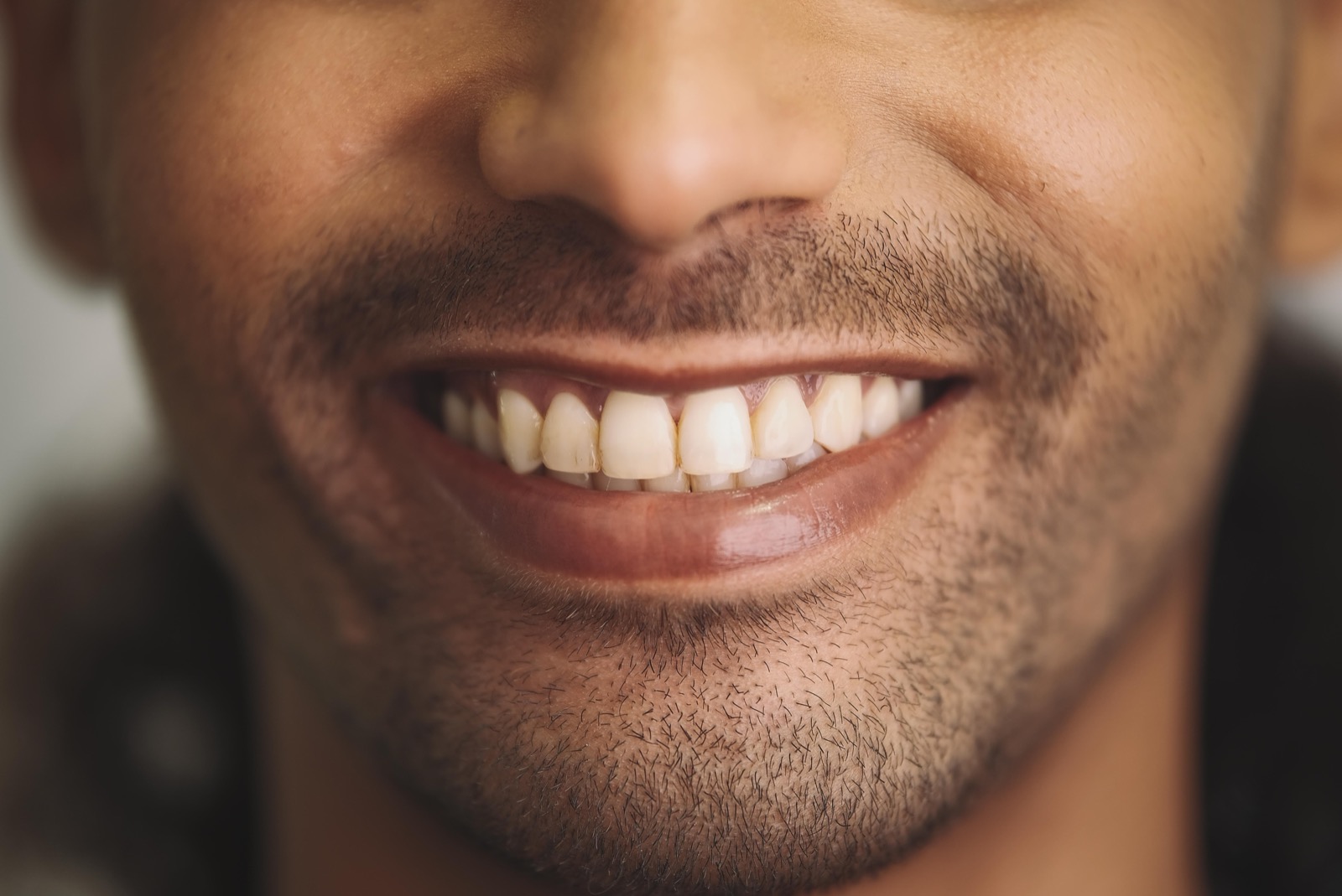 Male patient's natural smile before veneers