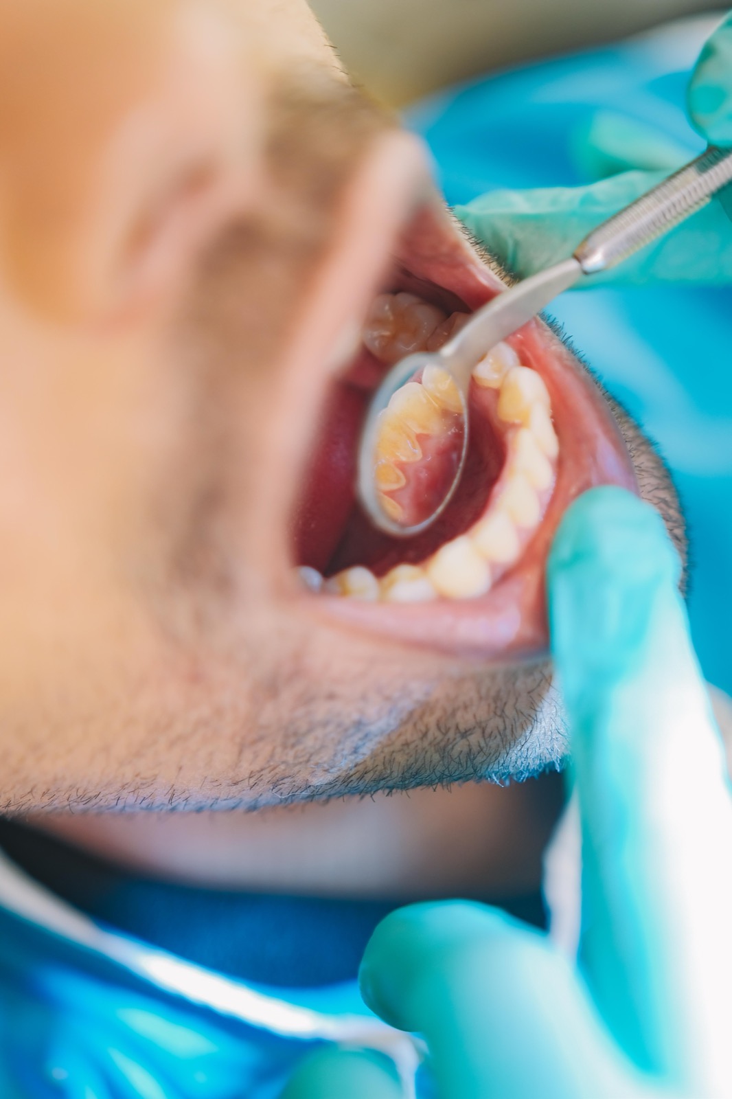 Clear aligner trays