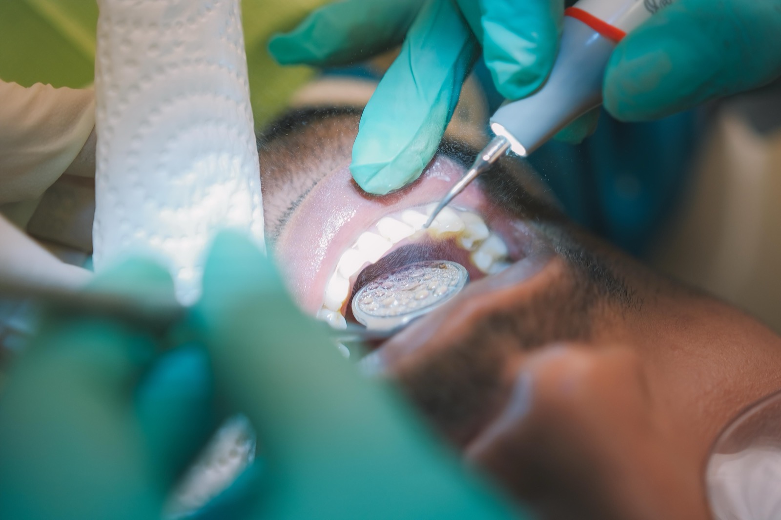Veneer consultation