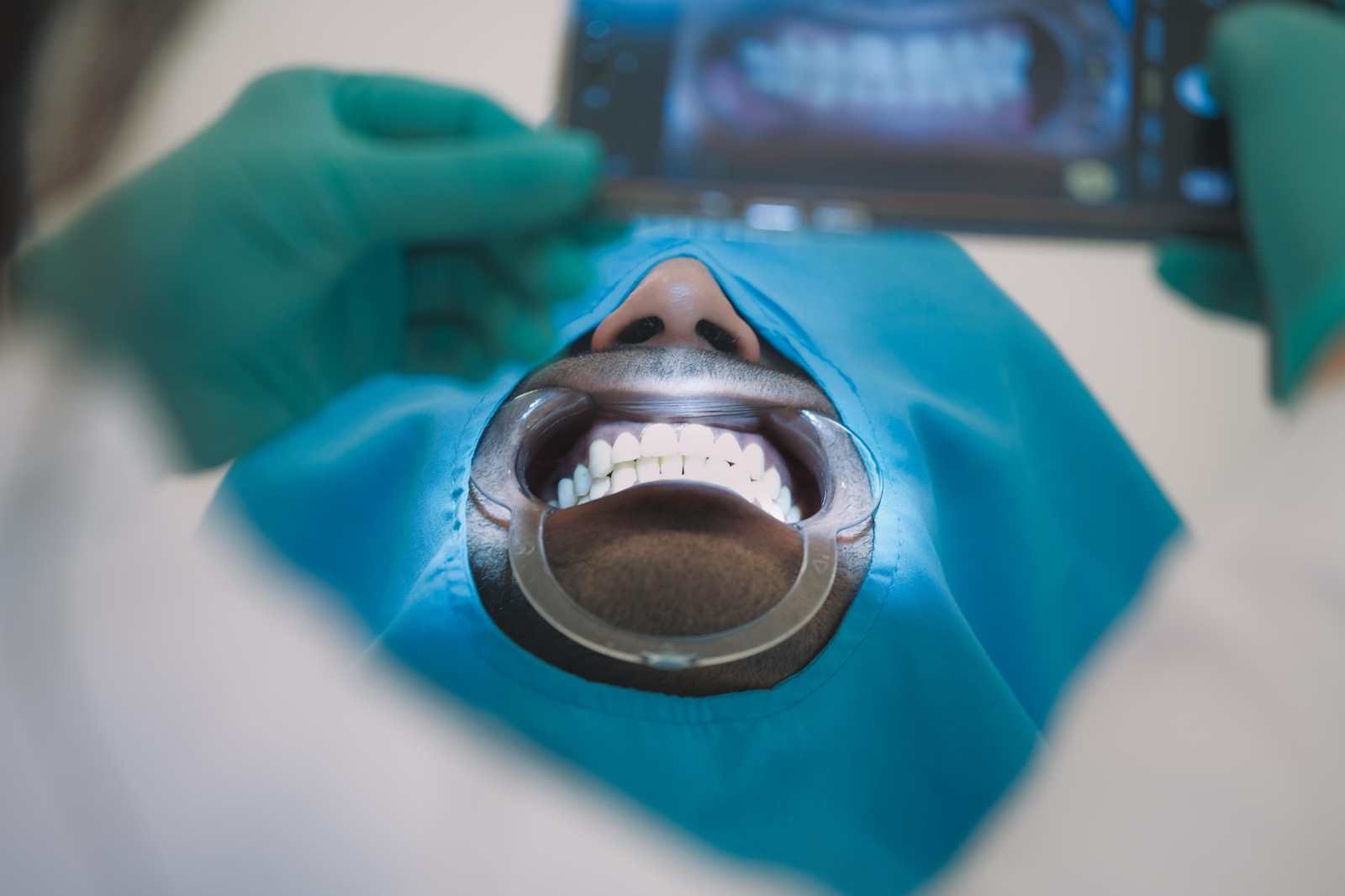 Patient's upper and lower teeth held with a retractor before root canal treatment