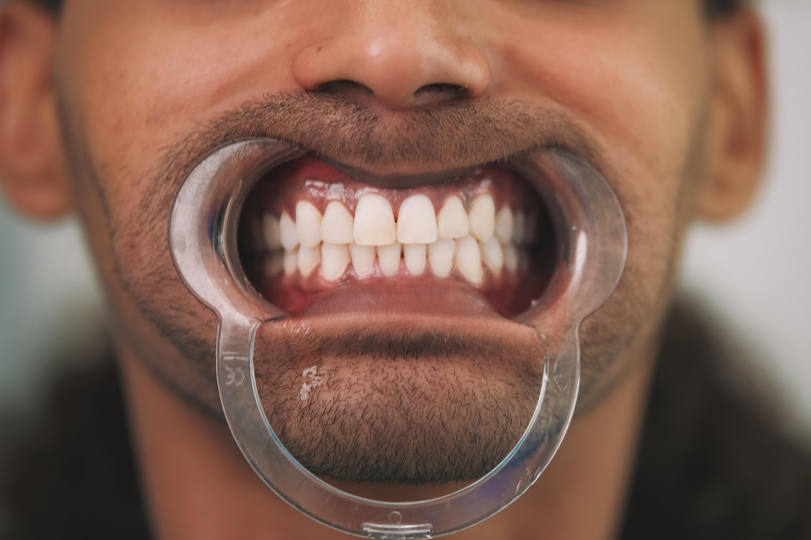 Close-up of a patient's teeth held with a cheek retractor before implant treatment
